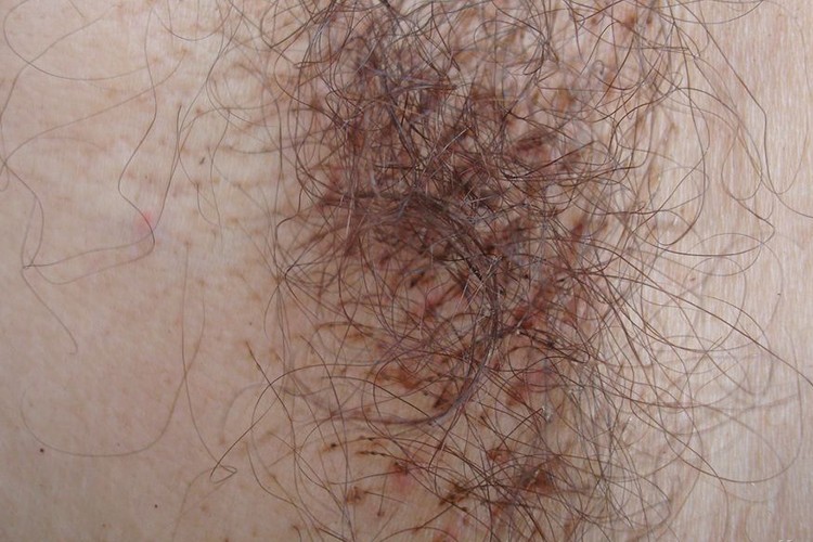 虱病腋窝红点图