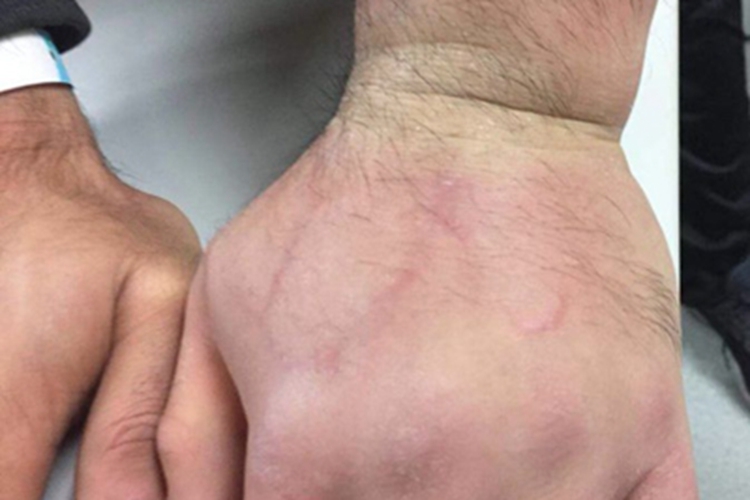 四肢血栓性浅静脉炎症状图