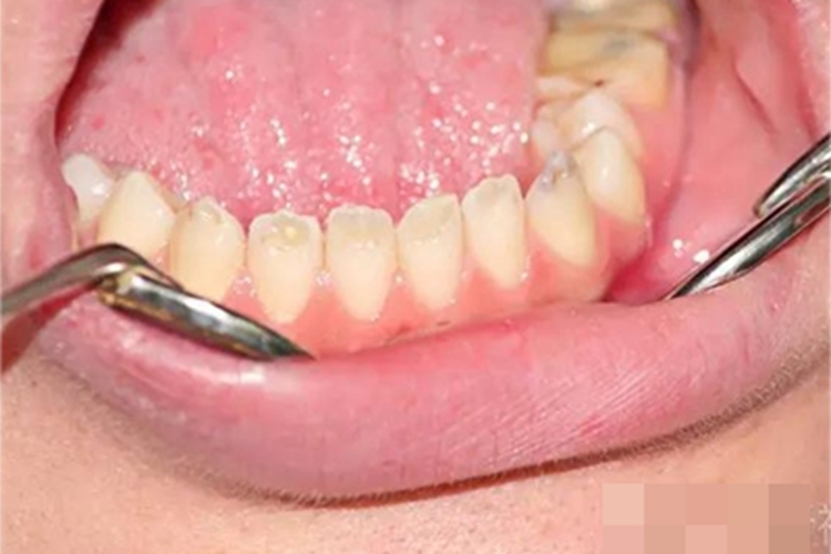 牙釉质发育不全牙齿变薄图 牙釉质发育不全牙齿变薄图