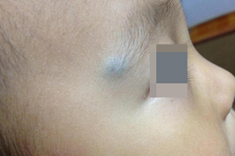 血管瘤面部皮肤发青图