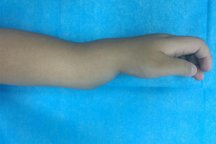 餐叉样畸形图 餐叉样畸形图