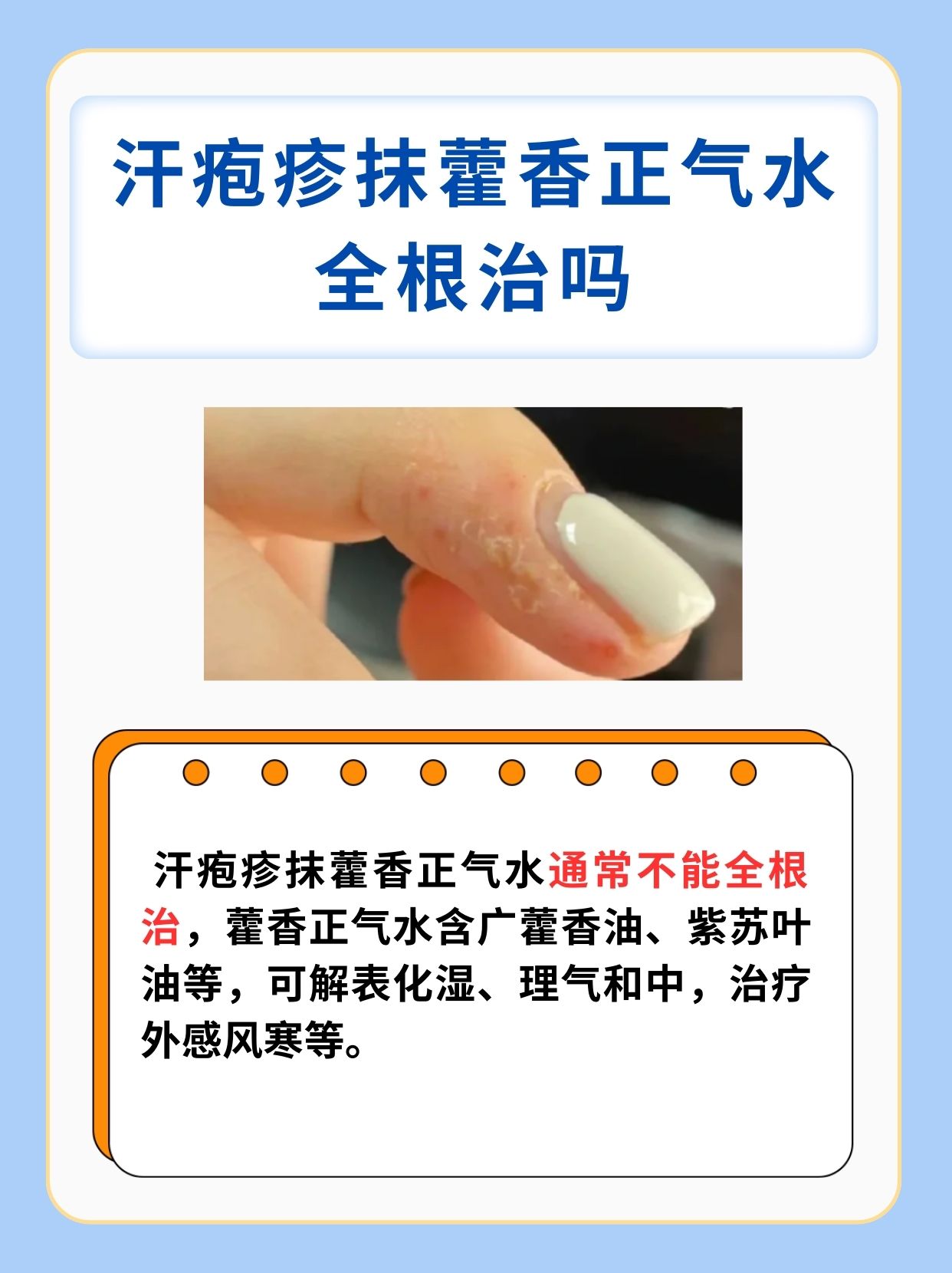 一文解析:汗疱疹抹藿香正气水全根治吗