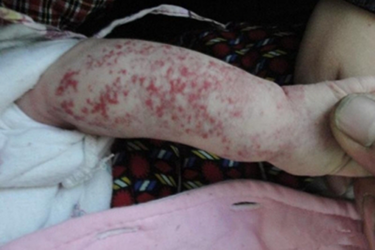 毛细血管瘤瘤图 毛细血管瘤瘤图