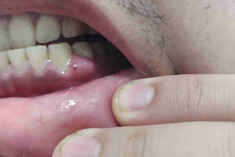 牙龈纤维瘤病牙龈包块图