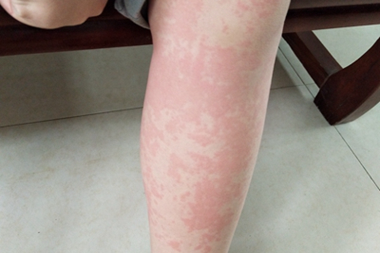 荨麻疹小腿红斑图 荨麻疹小腿红斑图