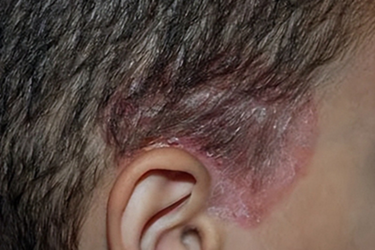 头皮脓疱糜烂性皮病头皮红斑图