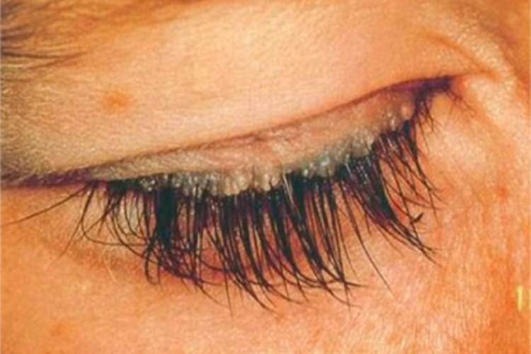 类脂蛋白沉积症睫毛根部小疙瘩图