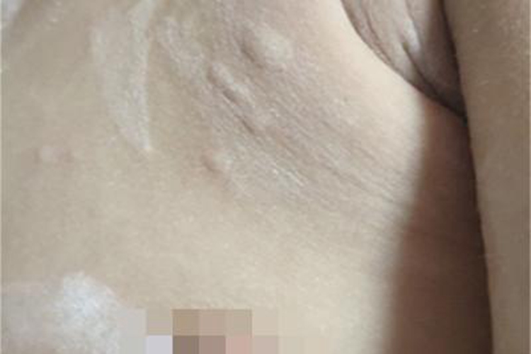 急性自发性荨麻疹胸部症状图