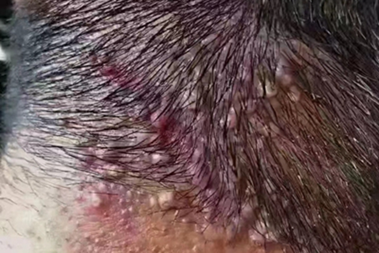 毛囊炎头皮脓包图 毛囊炎头皮脓包图