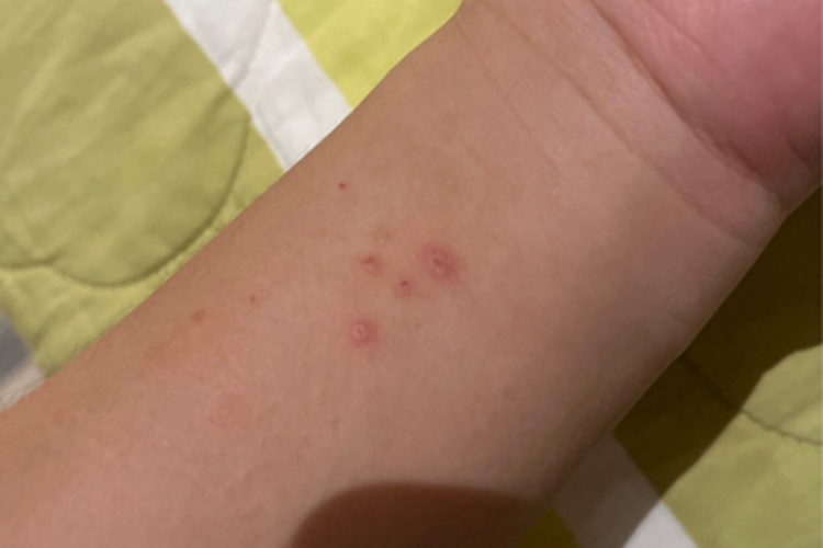 小儿痒疹小红疙瘩图