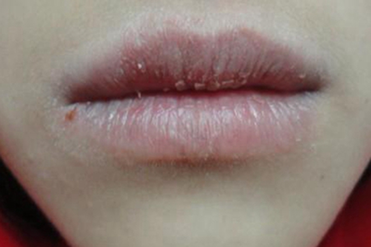 缺铁性贫血嘴唇发白图