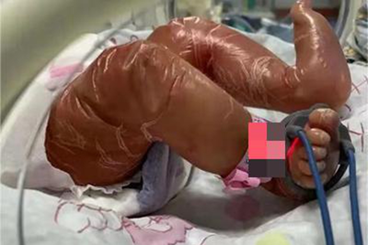 火棉胶婴儿腿部症状图