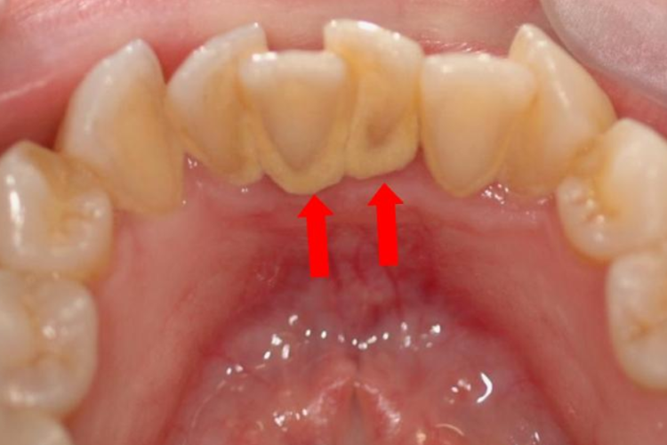 轻微牙结石图 轻微牙结石图