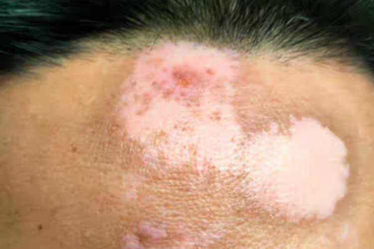 稳定期节段型白癜风症状图