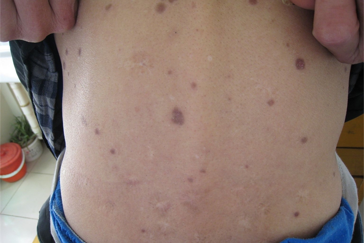 斑疹性梅毒疹背部症状图