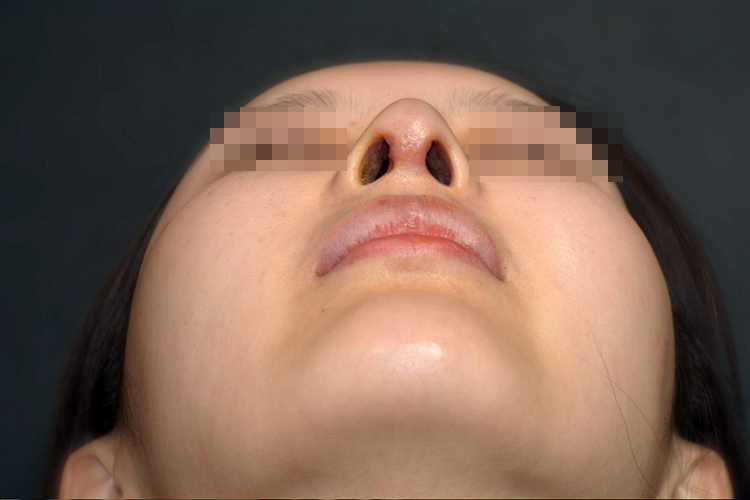 术后第6-7天基本恢复正常图 术后第6-7天基本恢复正常图