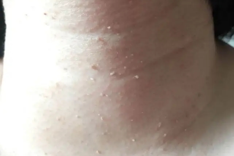 HPV感染脖子上长丝状疣图