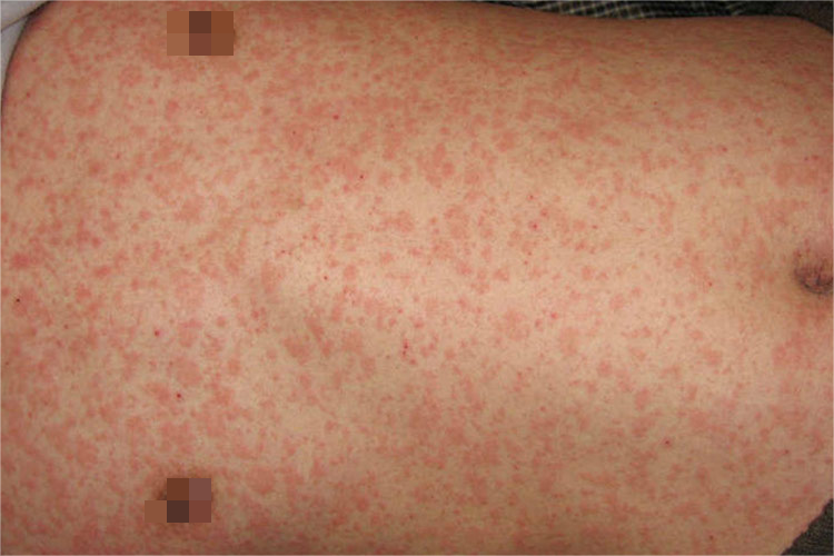 麻疹型药疹图