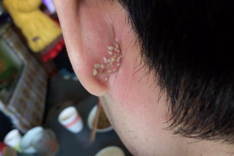 单纯疱疹耳后红肿图