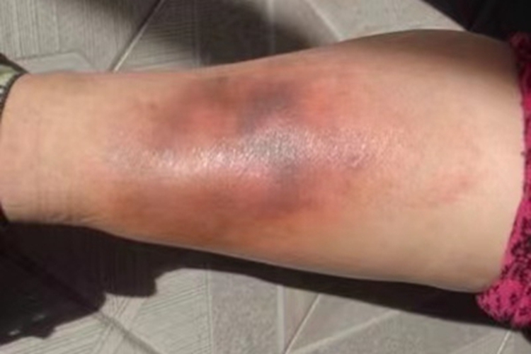 游走性血栓性浅静脉炎红肿图