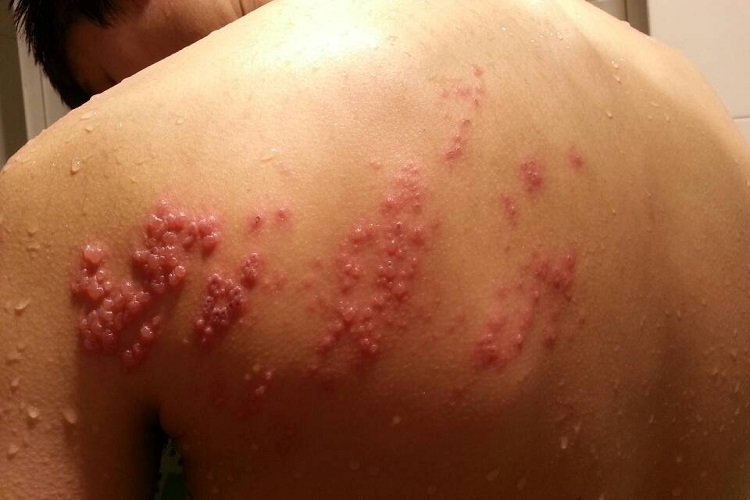 单纯疱疹水疱图 单纯疱疹水疱图