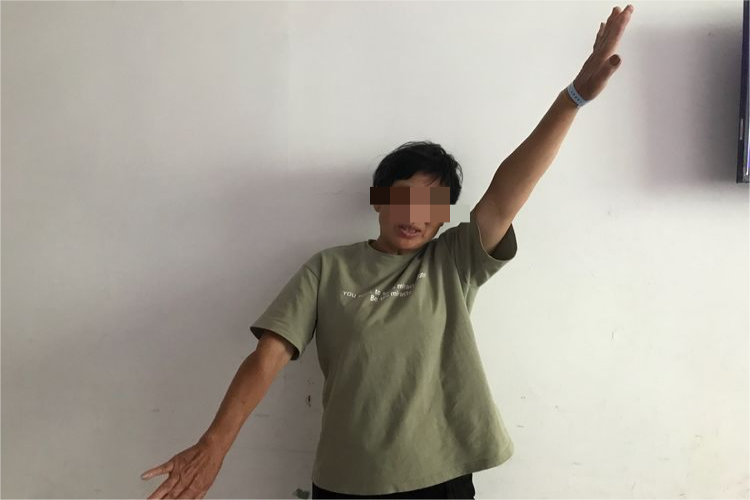 肩袖损伤上举活动受限图 肩袖损伤上举活动受限图