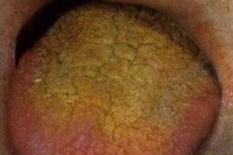 焦黄苔图 焦黄苔图