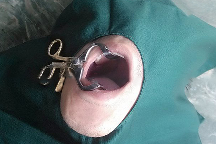 开口器放入口腔图