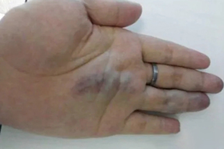 静脉畸形手掌症状图
