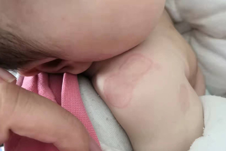 新生儿毒性红斑症状图