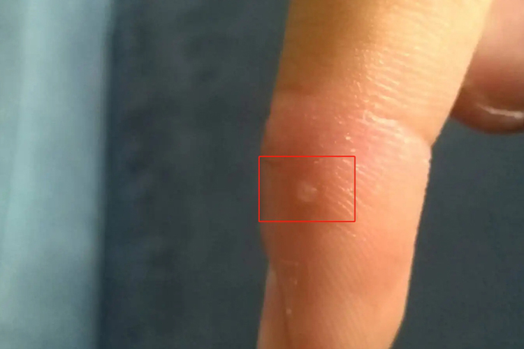 手指上起单个汗疱疹图