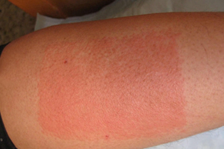 红皮病急性期大腿症状图 红皮病急性期大腿症状图