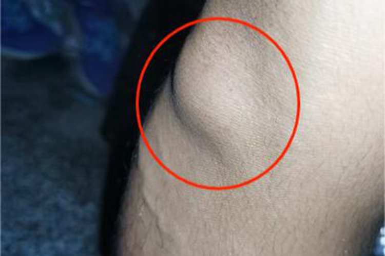 皮下脂肪瘤大腿软包图 皮下脂肪瘤大腿软包图