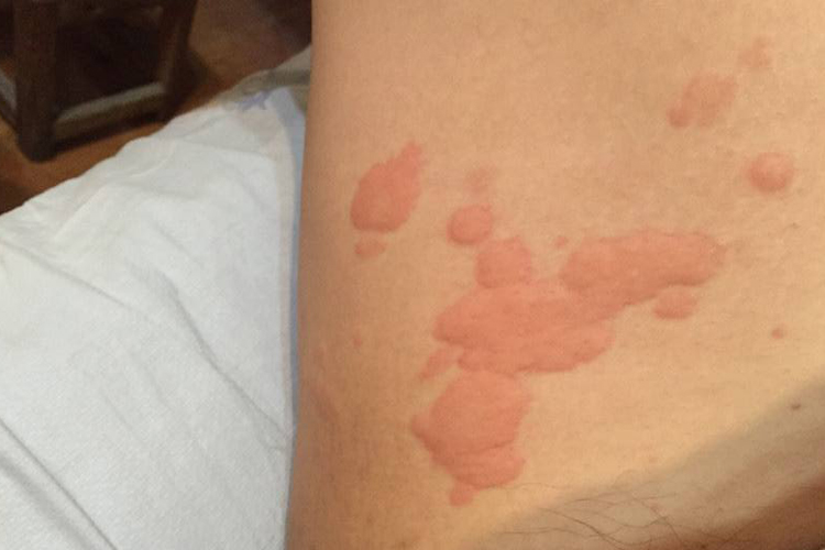 大腿内侧荨麻疹图