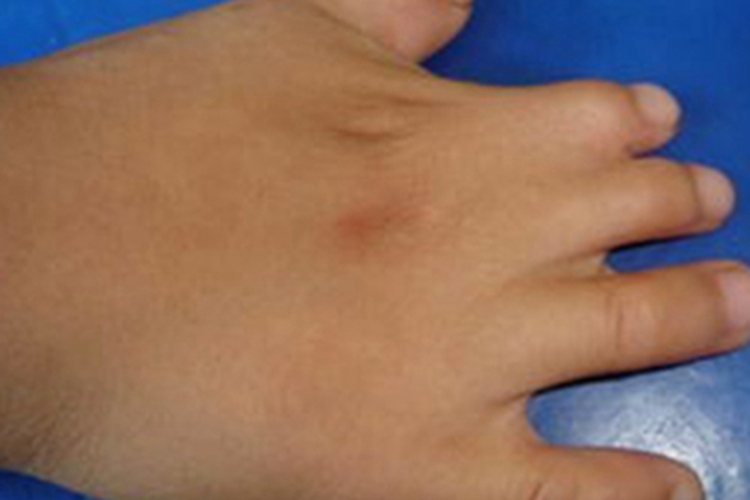 狭颅症手指连在一起图