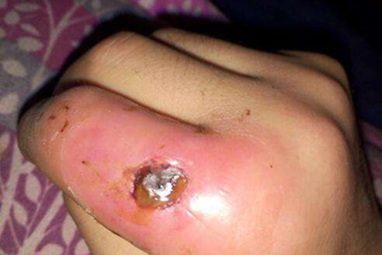 脓疱疮手部结痂图