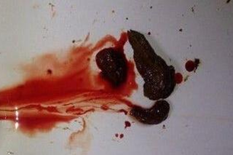 早期胃癌暗红色大便图