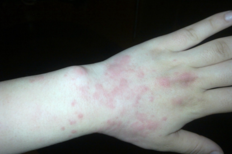 日光性荨麻疹手背症状图