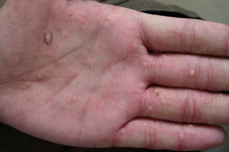 手上汗疱疹图