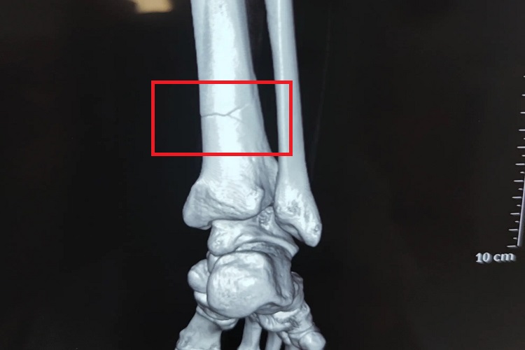 胫骨远端骨折三个月恢复图 胫骨远端骨折三个月恢复图