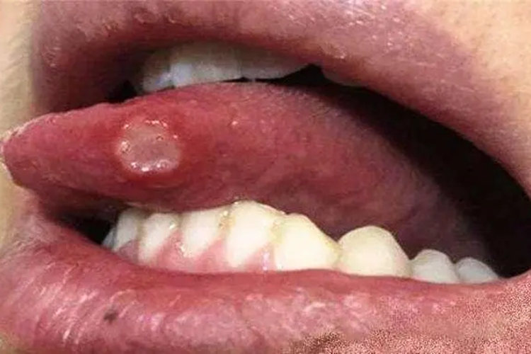 口腔溃疡舌头白色斑块图