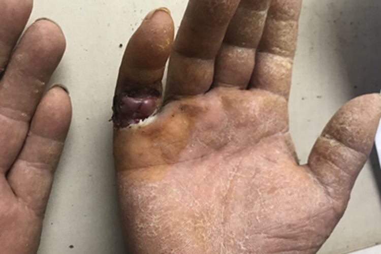 砷角化病手掌皮肤粗糙图