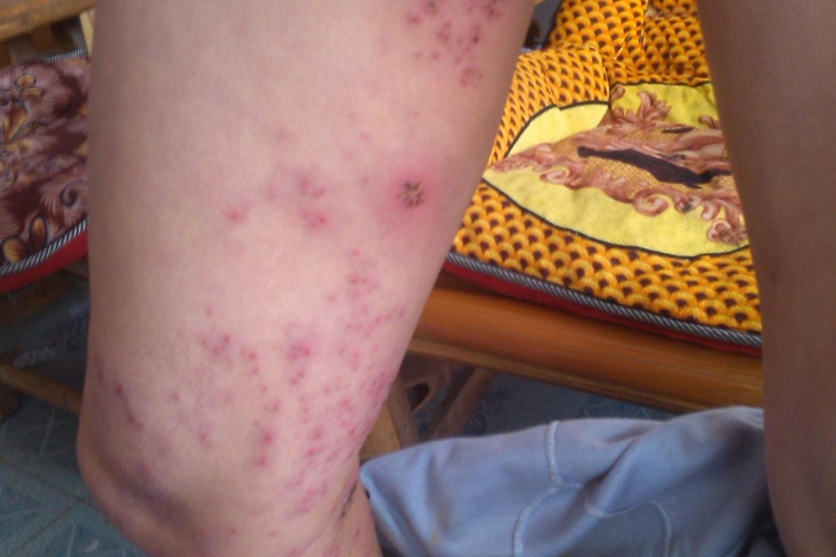 大腿内侧带状疱疹图