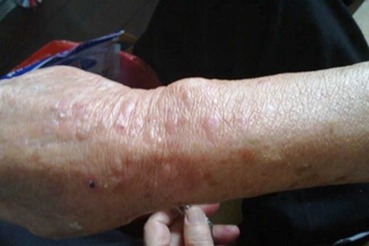 瘙痒症手腕结痂图 瘙痒症手腕结痂图