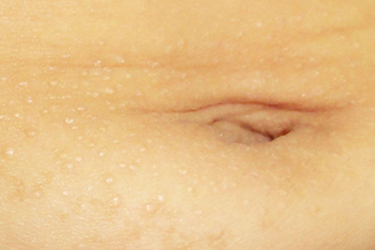 光泽苔藓腹部丘疹图