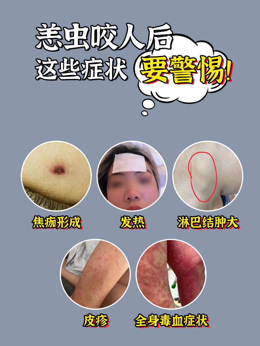恙虫咬人后，这些症状要警惕！