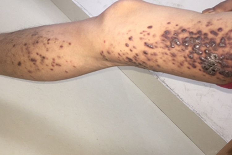 艾滋病皮肤肿瘤腿结节图 艾滋病皮肤肿瘤腿结节图
