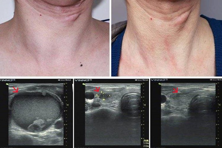 甲状腺消融手术后一个月图