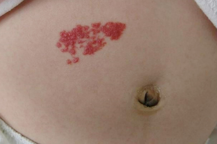 血管瘤图 血管瘤图