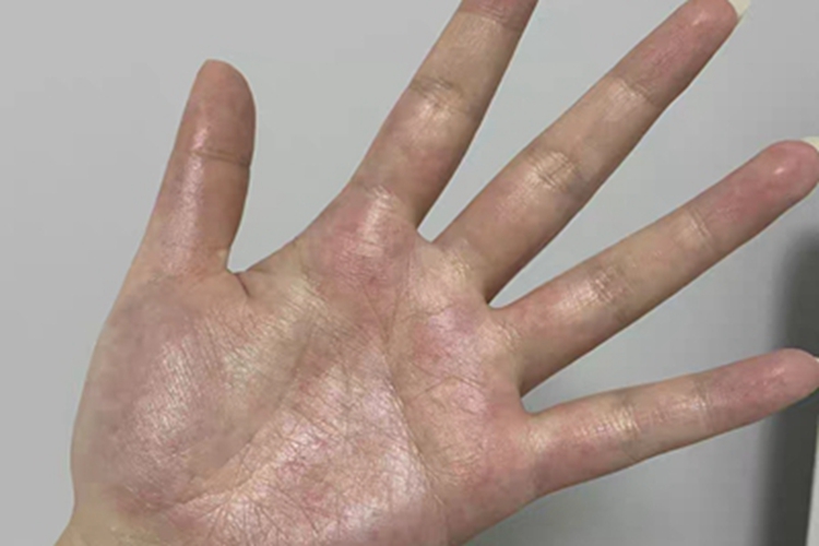接触性皮炎手掌红斑图 接触性皮炎手掌红斑图